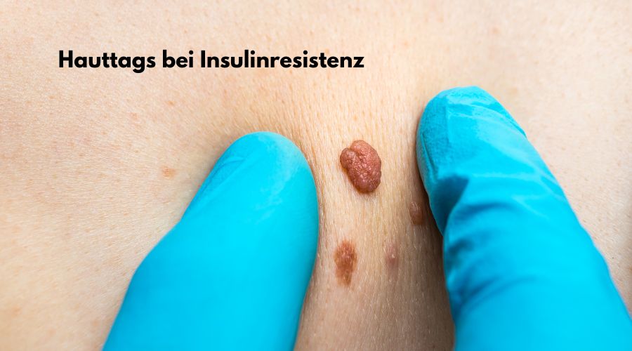 Hauttags Bei Insulinresistenz 